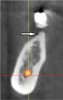 Fig 8. Deficient ridge contour at the osseous crest: cross-sectional view. This ridge (arrow) is not wide enough to receive an implant unless additional bone grafting is done to accommodate the implant’s width or the bone is reduced to a widened part of the ridge suitable for implant insertion.