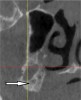 Fig 13. Maxillary tuberosity: cross-sectional view. Sometimes this site (arrow) is used to harvest bone graft material.