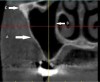 Fig 14. Maxillary sinus: cross-sectional view. A: Buccal wall. B: Medial wall. C: Zygomatic arch.