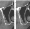 Fig 15. Maxillary sinus: cross-sectional view. A thickened Schneiderian membrane (arrow) is visible in this cross-section.