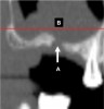 Fig 17. Maxillary sinus: section of a panoramic view. A: Fenestration of bone into the floor of the sinus. B: Thickened Schneiderian membrane.