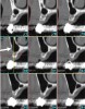 Fig 20. Maxillary sinus: Nine consecutive cross-sectional views. Arrow is pointing to large fenestration in buccal wall of the sinus.