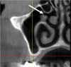 Fig 22. Ostium: cross-sectional view. The ostium is the opening from the sinus into the middle meatus of the nose (arrow).