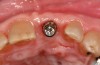 Fig 1. Incisal view (clinical) with impression coping in place demonstrating buccal angulation of implant.