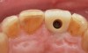 Fig 6. Incisal view (clinical) of implant-retained crown demonstrating ideal position of access opening in the cingulum using the angulated screw channel.