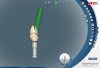 Fig 8. Sagittal view (digital) showing position of access opening on facial aspect of crown when implant angulation is “corrected” using angulated screw channel.