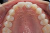 Fig 12. Incisal view (clinical) of crown Nos. 8 and 9.