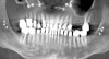 Fig 6. Panoramic radiograph of 56-year-old patient illustrating a number of dental procedures historically.