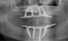 Fig 13. An All-on-4 approach was used to treat both arches with interim immediate and eventual definitive restorations.