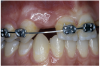 Figure 2a  Pretreatment buccal views showed (A) root convergence, (B) a difference in clinical appearance of the left lateral, and (C) significant crestal width of keratinized tissue.