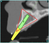 Figure 4b  CT scan data was input into the treatment-planning software, which allowed (A) placement of a simulated implant and (B) the determination of the “zone” for proper placement.