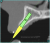 Figure 5a  The software (A) revealed a thinner facial-lingual crestal dimension, and (B) allowed a simulated bone graft to be placed.