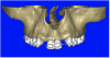 Figure 7a  The 3D reconstruction showed (A) the facial concavities and root eminences, and allowed (B) for evaluation of virtual implant placement to ensure the facial cortical plate was not perforated.