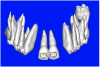 Figure 8b  By using the masking feature, the inner and outer layers of bone were removed virtually, revealing (A) the enamel and root structure of the teeth and the rotated position of the right central and (B) slight mesial dilacerations of the root apex.