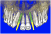 Figure 9a  Virtual implants were placed to determine the appropriate shape and type for the available space; in this case a tapered design allowed for adequate mesial-distal distance between adjacent roots.