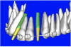 Figure 9b  Virtual implants were placed to determine the appropriate shape and type for the available space; in this case a tapered design allowed for adequate mesial-distal distance between adjacent roots.