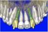 Figure 10a  By using the virtual teeth feature, (A) final implant and abutment positioning was checked, (B) the abutment projection evaluated for a cementable prosthesis, and (C) the appearance of the desired virtual restorations evaluated for emergence and esthetics.