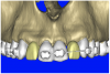Figure 10c  By using the virtual teeth feature, (A) final implant and abutment positioning was checked, (B) the abutment projection evaluated for a cementable prosthesis, and (C) the appearance of the desired virtual restorations evaluated for emergence and esthetics.