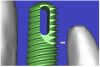 Figure 11b  By zooming in on the digital image, the implant-to-tooth distances can be assessed at the (A) crest and the (B) apex.