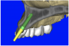 Figure 12a  (A) By sectioning the 3D model, virtual implant placement was assessed for the necessary 2 mm of facial and palatal bone surrounding the implant, and (B) by using segmentation techniques to remove the existing teeth, leaving the sockets, the alveolar complex was appreciated fully.