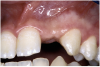 Figure 13c  Before implant surgery, the orthodontic brackets were removed, revealing (A) the position of the centrals, and (B, C) the anatomical variations of the crestal tissue and lack of interdental papilla.