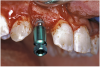 Figure 16b  After (A) the osteotomies were completed, (B) the implants were placed.