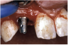 Figure 17b  By predetermining the necessary orientation of the restorative components, the implant’s antirotational hex was positioned correctly.