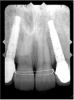 Figure 21  The final radiograph confirmed the fit of the abutment-implant-crown interfaces.