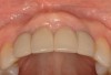 Fig 18. Facial (Fig 17) and occlusal (Fig 18) views, 3 years postoperative, of implants Nos. 7 and 10, fully guided with 3D placement of 3.3-mm x 12-mm implants with non-loading of both sites. Patient was high esthetic risk profile. Key Nos. 7 (SCTG) and 8 (immediate contour management) were not used. Facial bony concavity with loss of ridge width was noted on No. 7 along with show-through of titanium abutments (periodontist: Jeff Ganeles, DMD).