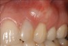 Fig 2. Miller Class I recession on tooth No. 11 (Fig 1) treated with tuberosity CTG (Fig 2). Note this CTG (which is the tuberosity CTG from Fig 5) was placed before the practitioner developed thinning techniques, so a keloid-like appearance was observed even 1 year after grafting.