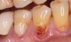 Fig 3. Tooth No. 28 had a Class V filling that failed with recurrent decay (Fig 3). A tuberosity CTG with a 1.5 mm thickness was placed, and after 1 year there was no keloid-like appearance (Fig 4).