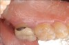 Fig 6. Pre- (Fig 5) and post- (Fig 6) DGV procedure. Note the 7-mm pocket distal to tooth No. 15 before treatment and normal probing depth after treatment. It would have been easier for the restorative dentist to place this crown with increased tooth structure if the tuberosity tissue had been removed previously.