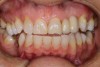 Fig 7. Seibert Class I defect in teeth Nos. 10 and 11 with Miller Class I to II recession on multiple teeth (Fig 7). A tuberosity CTG was used to treat the edentulous area at Nos. 10 and 11 and the periodontal recession on teeth Nos. 7 and 9. Allograft material was used to treat the other areas of periodontal recession. The final esthetic restorative treatment was completed with crowns on all upper teeth except for a bridge from Nos. 8 through 12 with ovate pontics in Nos. 10 and 11 (Fig 8). Note a keloid-like appearance was evident over teeth Nos. 7 and 9 due to ineffective trimming of the grafts (restorative treatment completed by Todd D. Gruen, DDS).