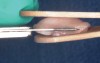 Fig 13. Fileting tissue to 1.5 mm thick utilizing a sandwich technique with saline-soaked tongue blades (Fig 13). Three grafts measuring 10 mm x 10 mm, 10 mm x 12 mm, and 10 mm x 15 mm were created from one tuberosity (Fig 14 and Fig 15).