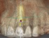 Fig 3. Pretreatment site-specific CBCT showing thick intact buccal plate and class 1 sagittal root position. Preplanning with a bone-level 4.1-mm diameter implant assured a 3-mm buccal gap upon placement and a screw-retained position.