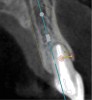 Fig 4. Pretreatment site-specific CBCT showing thick intact buccal plate and class 1 sagittal root position. Preplanning with a bone-level 4.1-mm diameter implant assured a 3-mm buccal gap upon placement and a screw-retained position.