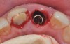 Fig 5. Palatal wall placement of implant. Anatomically correct surgical guide template assured a screw-retained position and correct vertical depth.