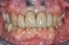 Fig 14. An 11-year follow-up of a case treated in 2006 with a thick periodontal biotype, thick intact buccal crest after flapless surgical extraction, immediate 3D implant placement (4.1 mm x 4.8 mm x 12 mm), buccal gap bone grafting with a low-substitution DBBM, and immediate screw-retained provisional. Key No. 7 (SCTG) was not used in the restoration process, yet no mid-buccal recession/esthetic complication was noted (periodontist: Robert A. Levine, DDS; restorative dentist: Zola Makrauer, DMD).