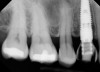 The narrowed abutment emergence profile will minimize encroachment on the peri-implant
bone. This design will help to preserve the peri-implant tissue and may enhance the final outcome.