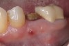 Fig 1. (Case 1) Tooth No. 19 manifested a buccal fistulous tract. Probing depth on the buccal was 8 mm.