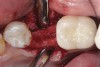 Fig 10. At 3 months postoperative, the flap was elevated, demonstrating a restored buccal plate of bone.