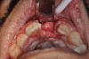 Fig 13. Flap elevated 6 months after d-PTFE barrier and bone graft were placed; the barrier was removed after 4 weeks. This photograph shows the buccal plate regenerated.