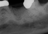 Fig 17. Bone graft was placed in the socket and a d-PTFE barrier was used to cover the graft. The bone graft material was placed beyond the alveolar housing to accommodate shrinkage of graft material and to facilitate attaining a wide alveolar ridge. The barrier was removed after 6 weeks.