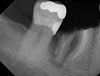 Fig 20. (Case 4) Radiograph of tooth No. 30, which had a hopeless prognosis.