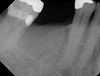 Fig 22. Bone graft was placed in the socket and a d-PTFE barrier was used to cover the graft. The bone graft material was placed beyond the alveolar housing to accommodate shrinkage of graft material and to facilitate attaining a wide alveolar ridge. The barrier was removed after 5 weeks.