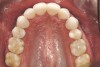 Fig 7 (and Fig 6). Prerestorative orthodontics was completed in 5 months. Final result 3 years, 4 months after completion.