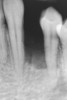 Figure 7  Radiograph of residual ridge defect in site No. 22.