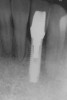Figure 23  Postoperative radiograph of zirconia abutment.