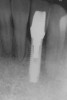 Figure 23  Postoperative radiograph of zirconia abutment.
