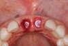 Fig 10. Healing abutments were placed, and implant/alveoli gaps were managed with placement of anorganic bovine bone.